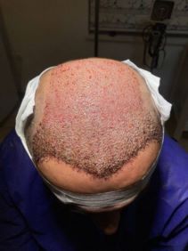 کاشت مو  جراحی زیبایی